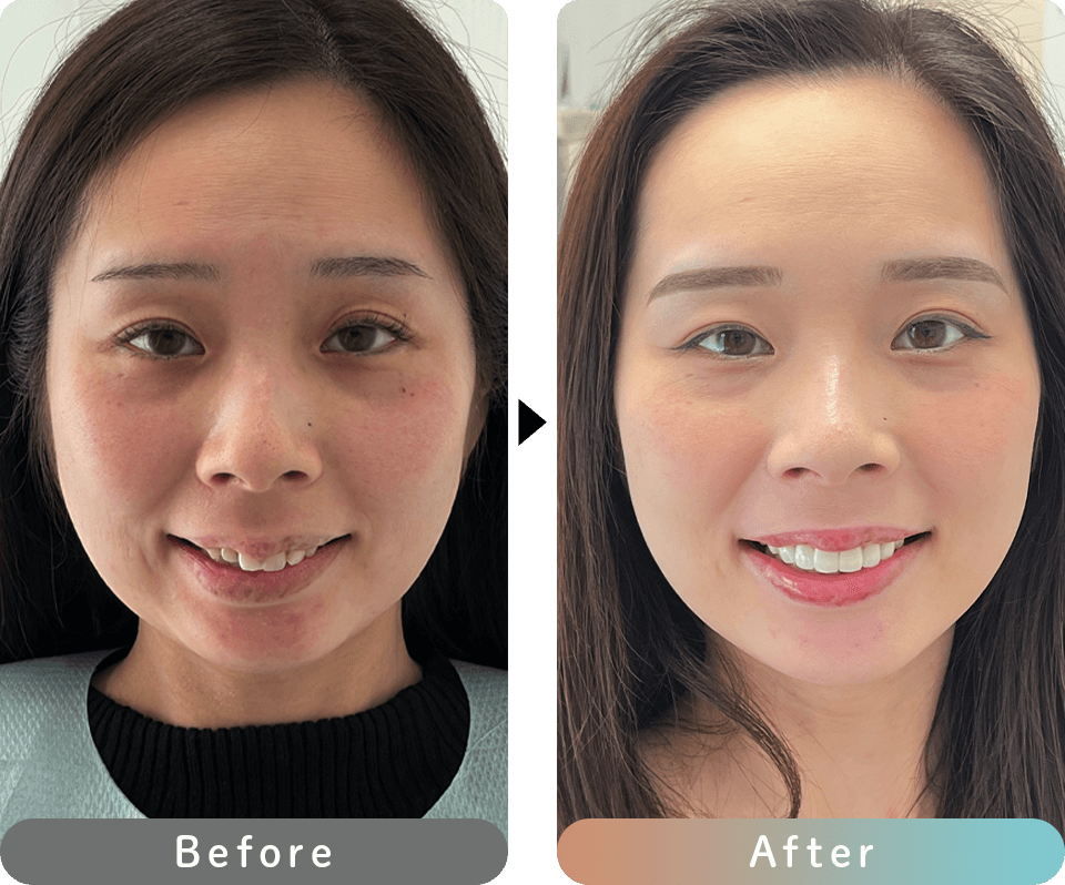 プレミアムダイヤモンドセラミック 症例写真1 正面 before after