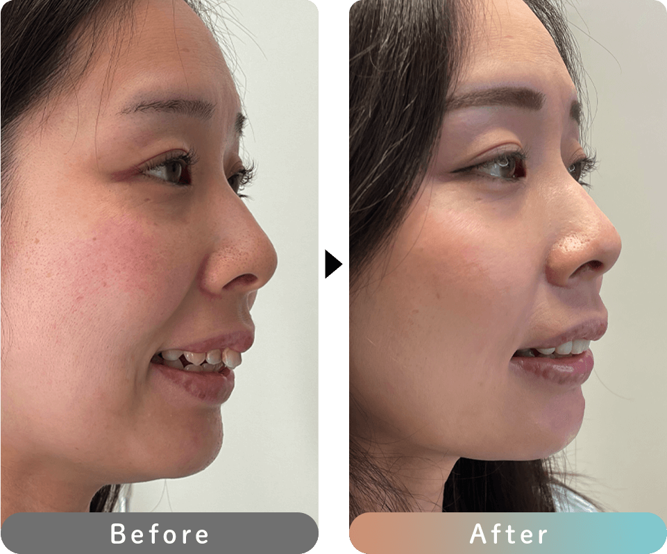 プレミアムダイヤモンドセラミック 症例写真1 横顔 before after