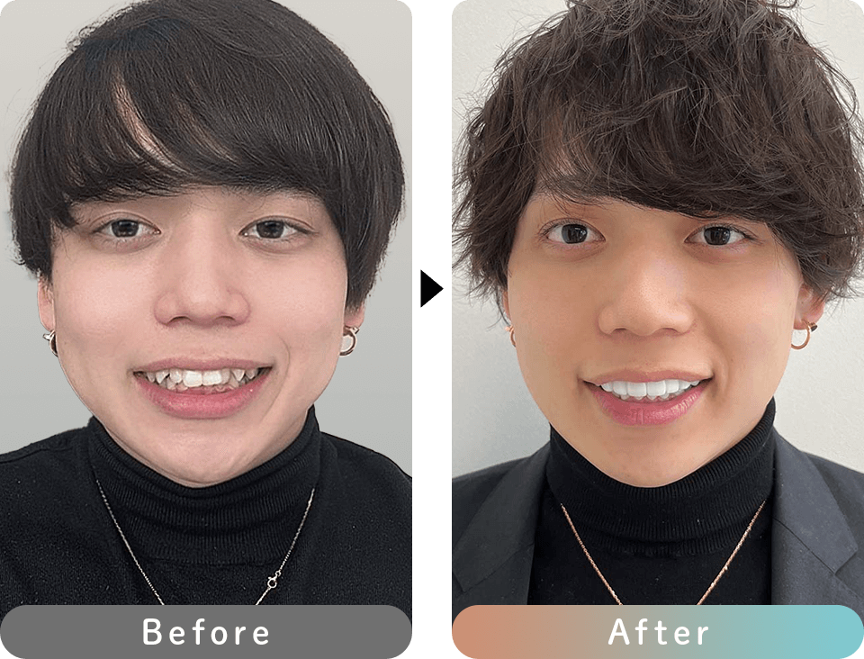 プレミアムダイヤモンドセラミック 症例写真12 before after