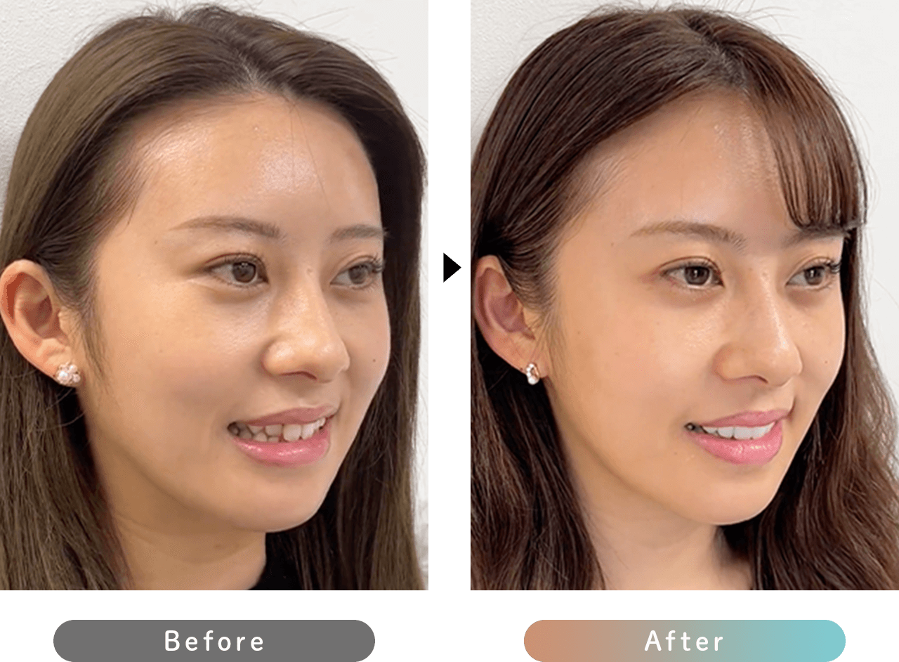 プレミアムダイヤモンドセラミック 症例写真ピックアップ before after