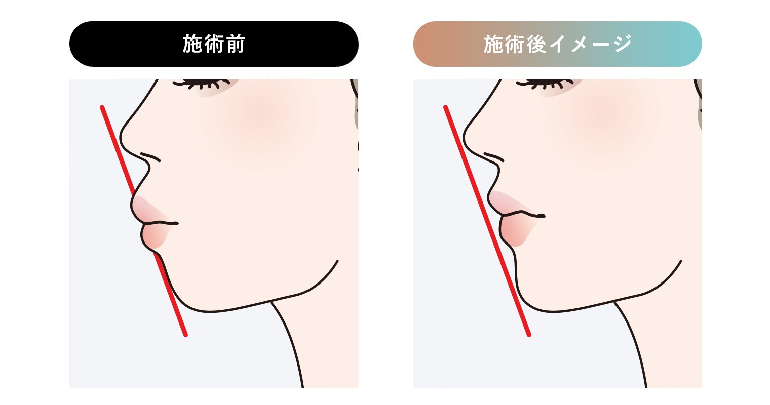 施術前・背術後イメージ