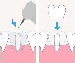 step4：歯の周りを削り噛みあわせや形を確認
