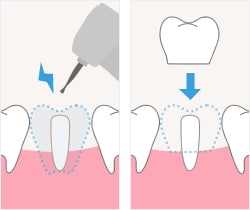 step4：歯の周りを削り噛みあわせや形を確認