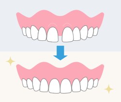 step6：仮歯の装着
