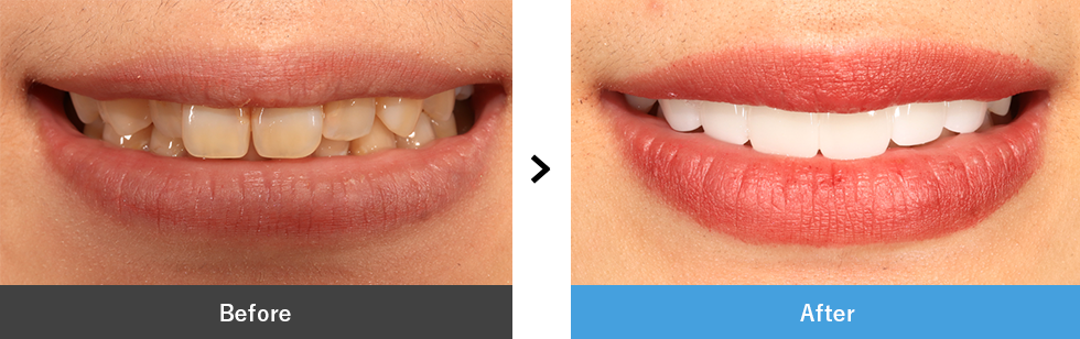 セラミック 症例写真