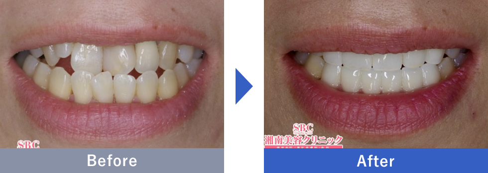 受け口の症例写真（20代女性）①