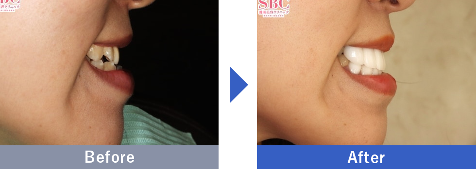 受け口の症例写真（30代女性）②
