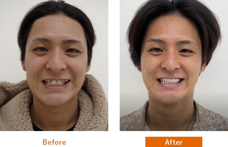 Before After