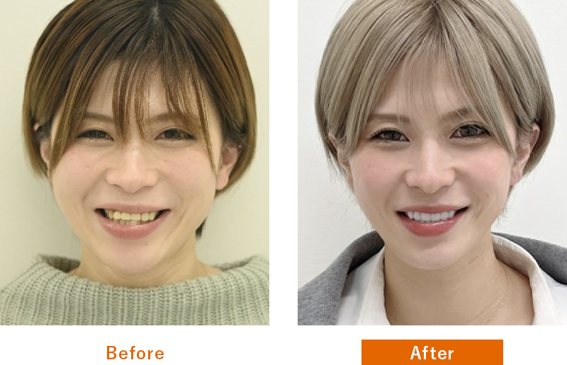 Before After