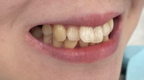 湘南マウスピース 症例写真01 before
