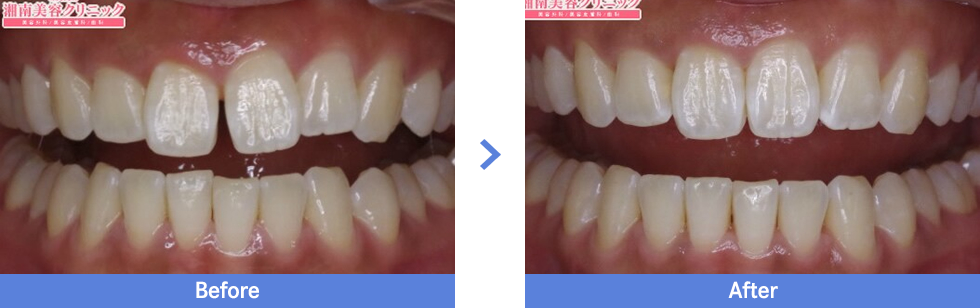 インビザラインの症例写真（前歯の隙間の改善）