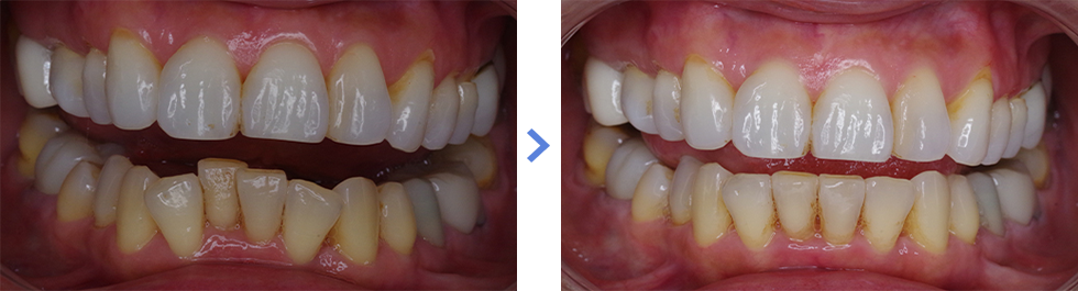 湘南マウスピースの下の歯の症例写真