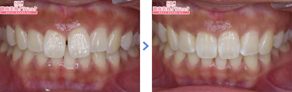 インビザラインの前歯の症例写真