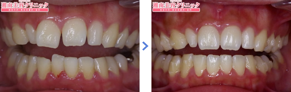 インビザラインのガタガタした歯並び（叢生）の症例写真