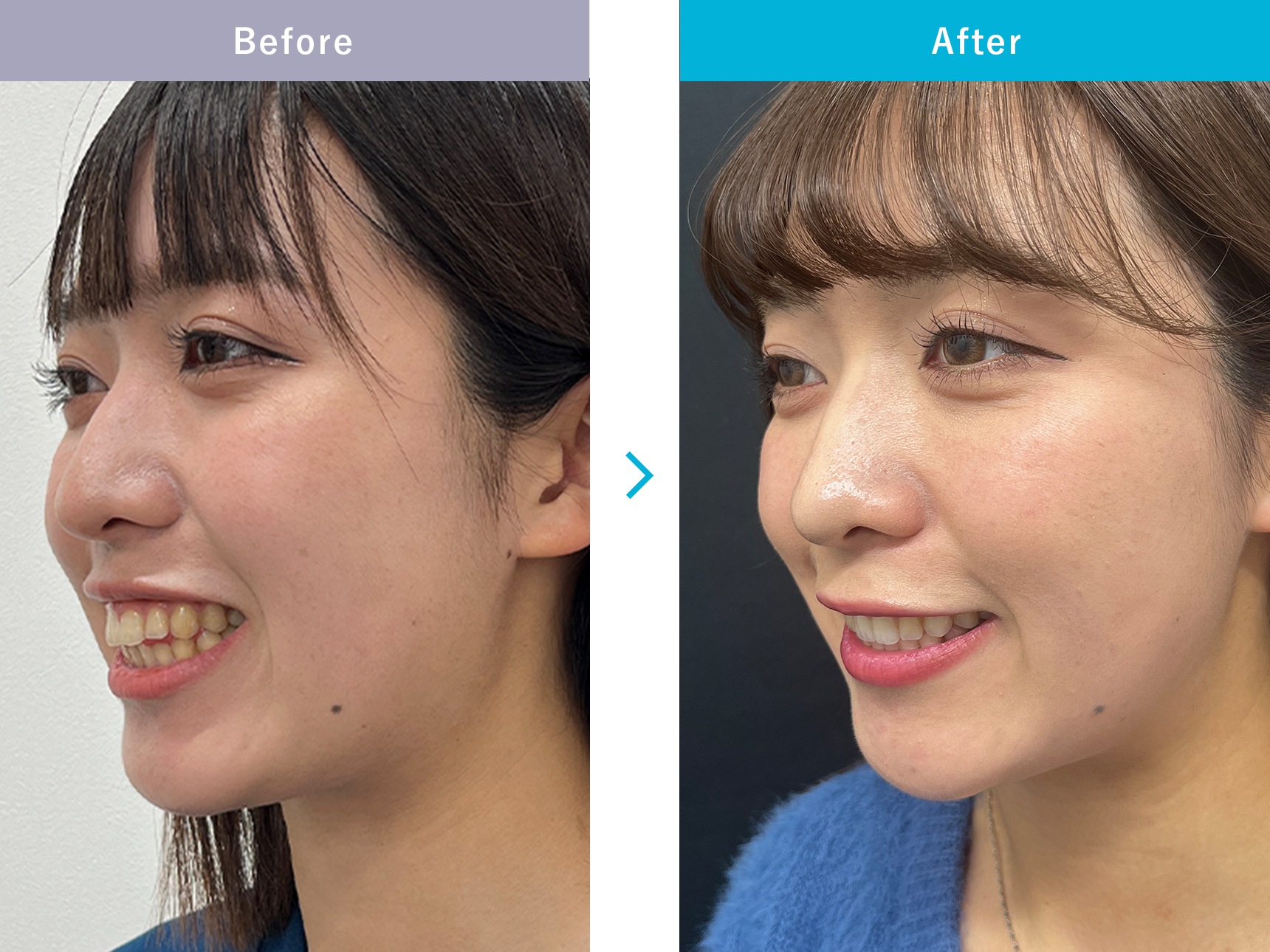 インビザラインモデレートの症例写真