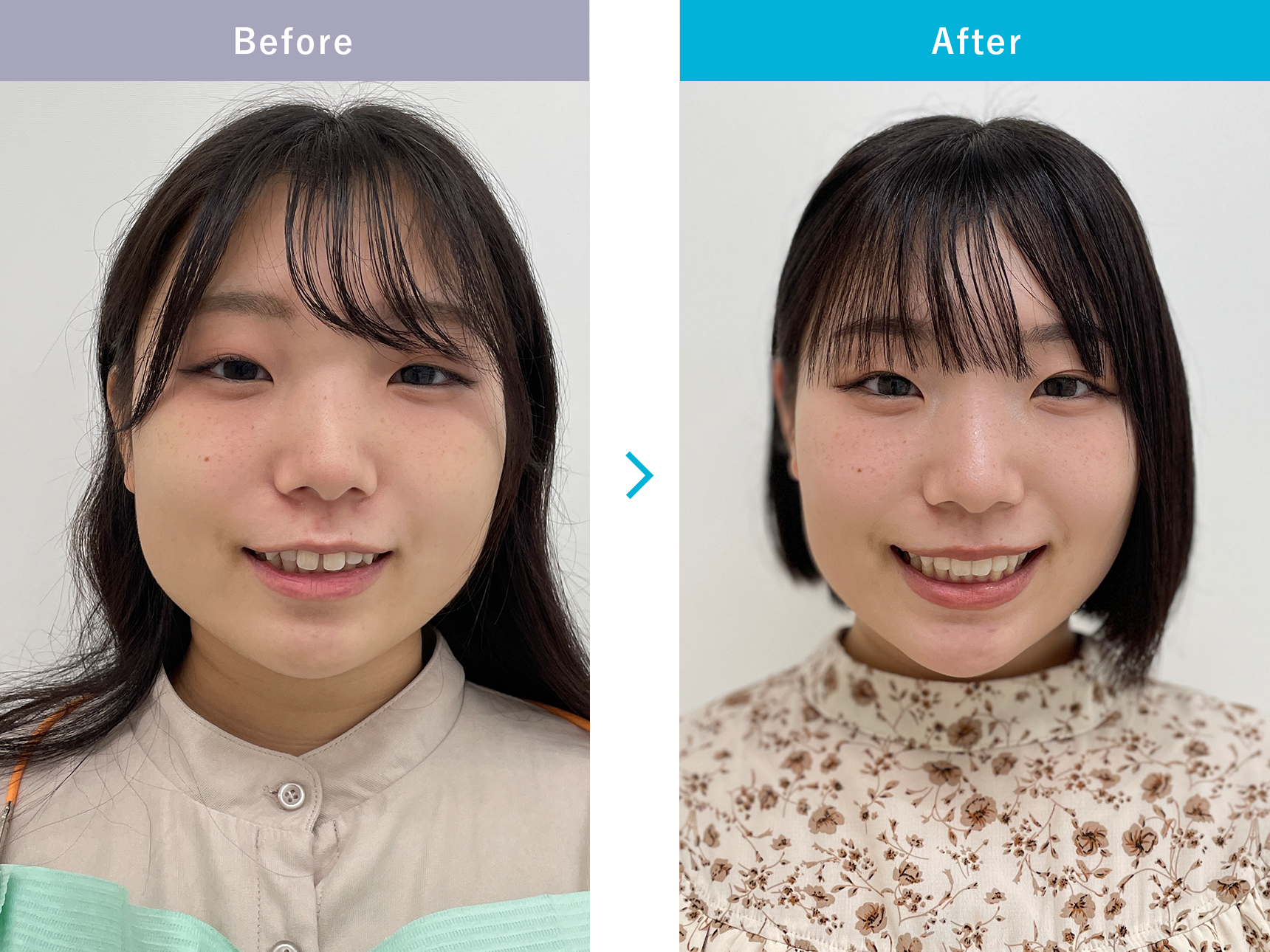 インビザラインGOの症例写真