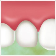 金属の除去～虫歯の除去