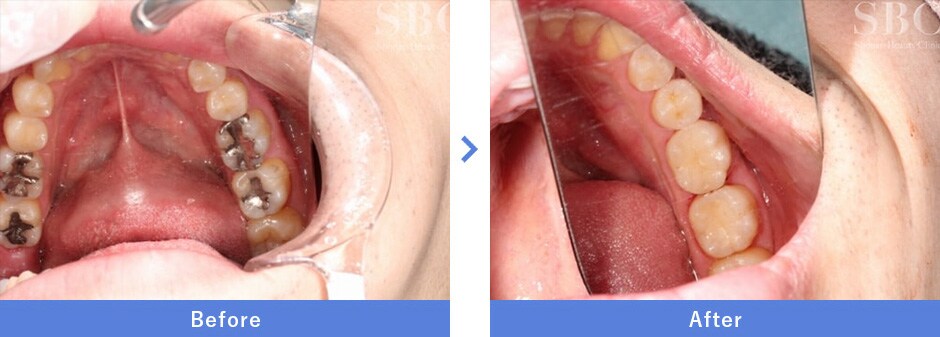 セラミックインレーの症例写真3
