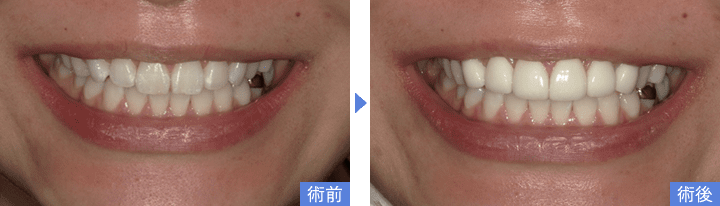 削らないラミネートべニアでホワイトスポット(白濁)を改善した写真