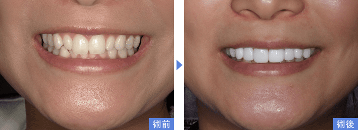 削らないラミネートべニアで歯の形(大きさ)を改善した写真