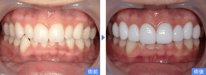 削らないラミネートべニアで歯の形(大きさ)を改善した写真(拡大)