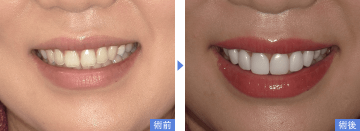 歯を削らないラミネートべニアで歯の色を改善した写真(拡大)