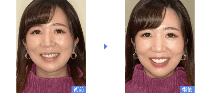 歯を削らないラミネートべニアで歯の色を改善した写真