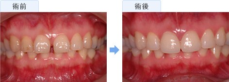 ラミネートべニア治療前後の写真