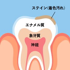 生活習慣による歯の表面の着色