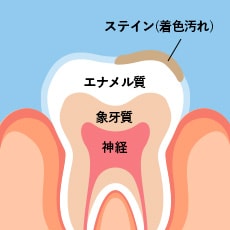 生活習慣による歯の表面の着色