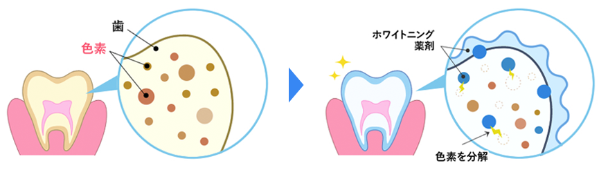 過酸化水素ホワイトニングの使用により「歯を白く」