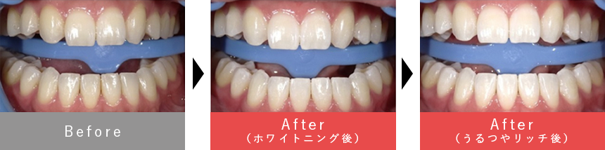 スタンダードホワイトニング（オフィスホワイトニング）＋うるつやリッチ 症例１