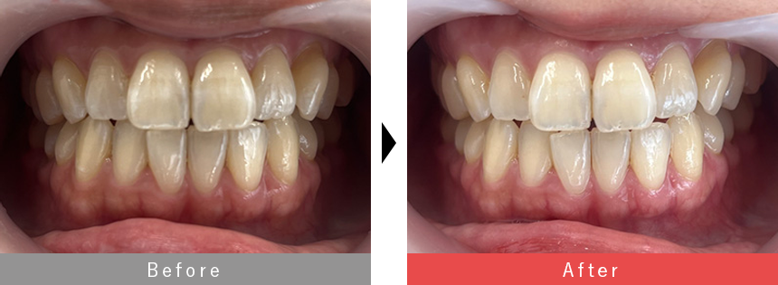 インビザライン