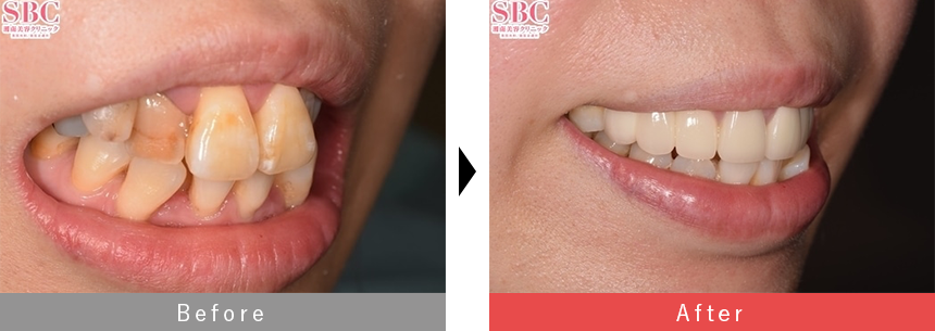 プレミアムダイヤモンドセラミック