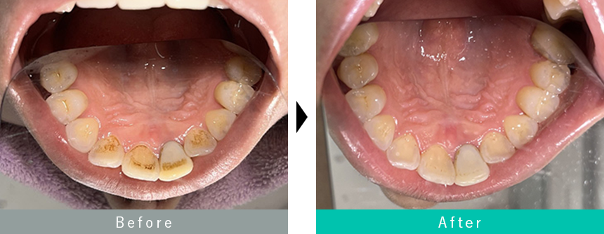 出っ歯のセラミック治療の症例