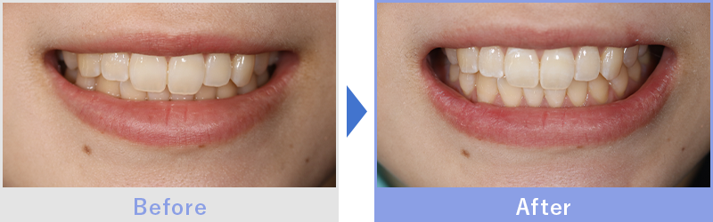 ピックアップ症例写真1 before after