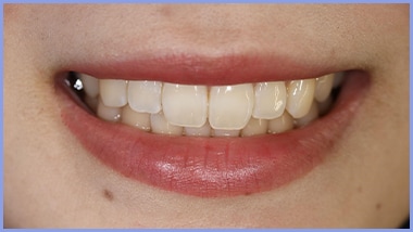 歯質改善トリートメント＆シートホワイトニング14日間施術後