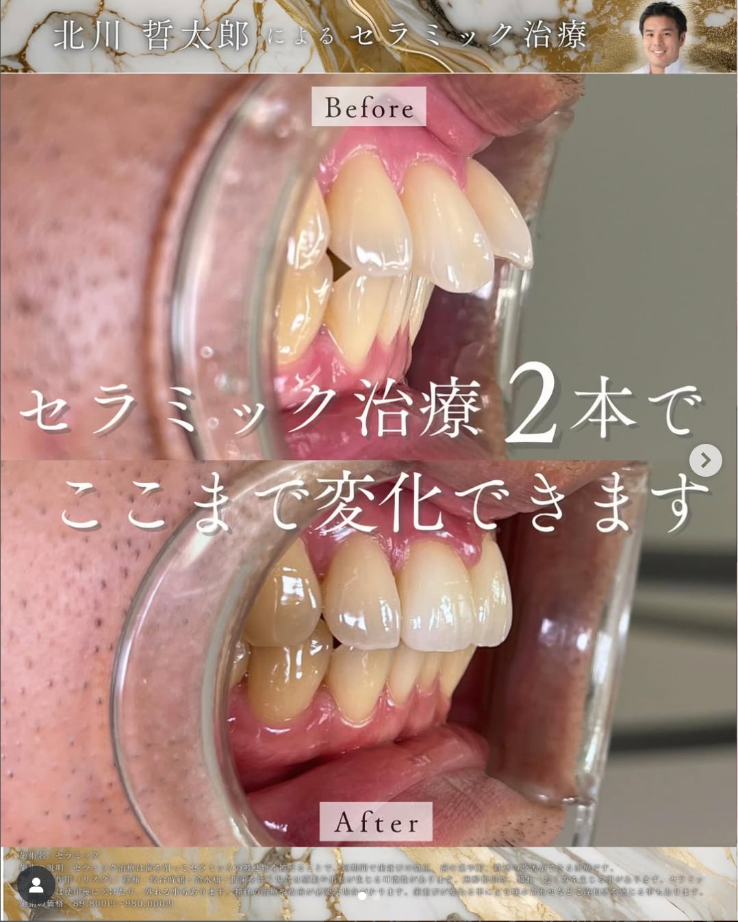 セラミック矯正（クラウン）