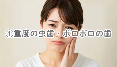 ①重度の虫歯やボロボロになった歯