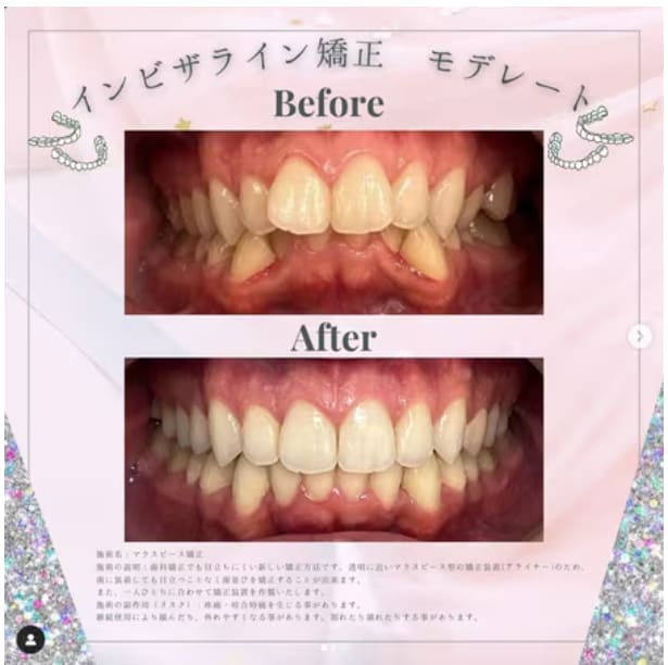 投稿①【インビザライン モデレート】