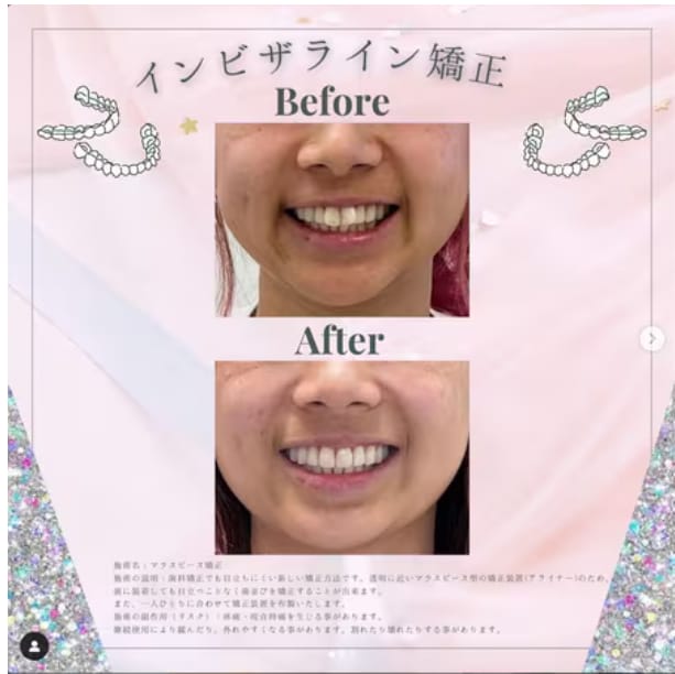 投稿②【インビザライン】