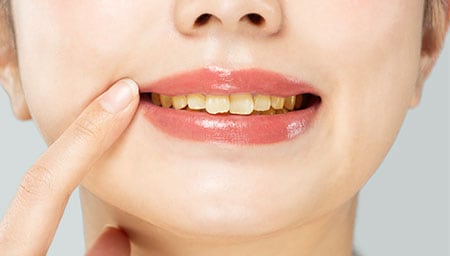 歯の黄ばみを予防する方法はありますか?