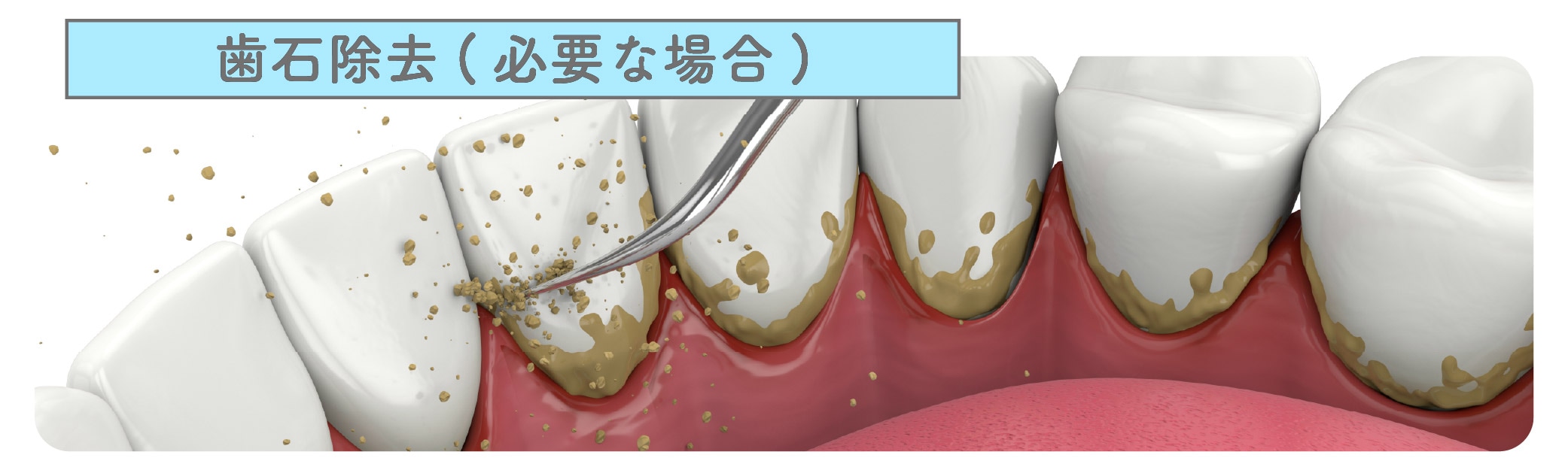 3.歯石除去(必要な場合)