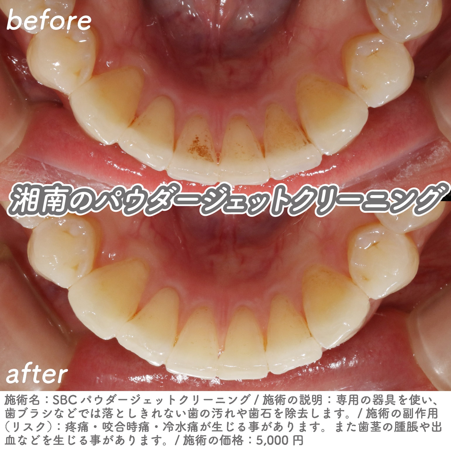 天神で歯の着色汚れに悩むあなたへ｜「パウダージェットクリーニング」で輝く白い歯に