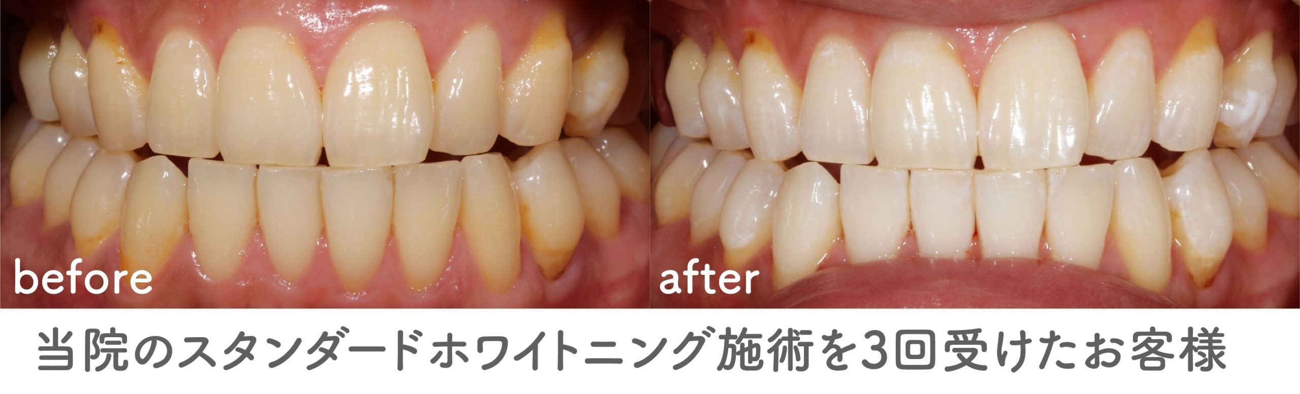時間がない方や早く歯を白くしたい方にもオススメのホワイトニング