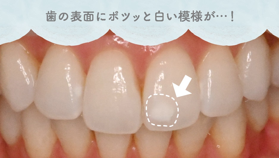 ホワイトスポットって何？