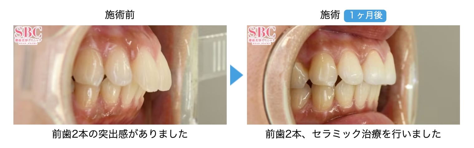 ダイヤモンドオーダーセラミック