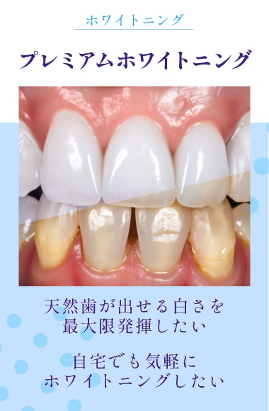 【 短時間で効果実感！】黄ばみのない白い歯に！