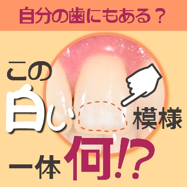 【池袋のホワイトスポット治療】iCON（アイコン）で削らず自然な白さに