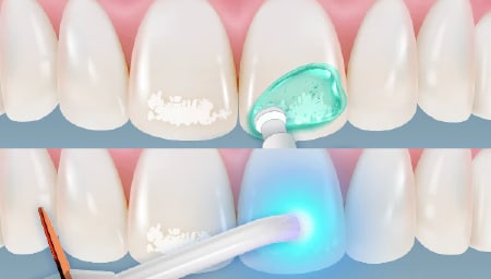 樹脂塗布・光照射